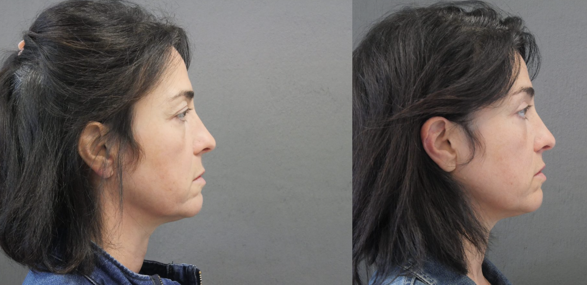 blépharoplastie jessica marthan