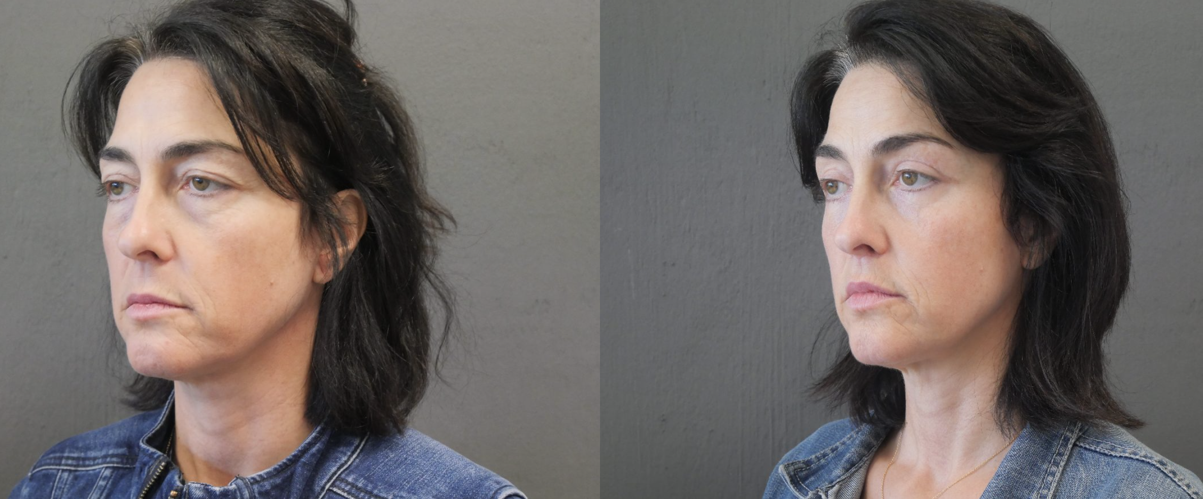 blépharoplastie jessica marthan