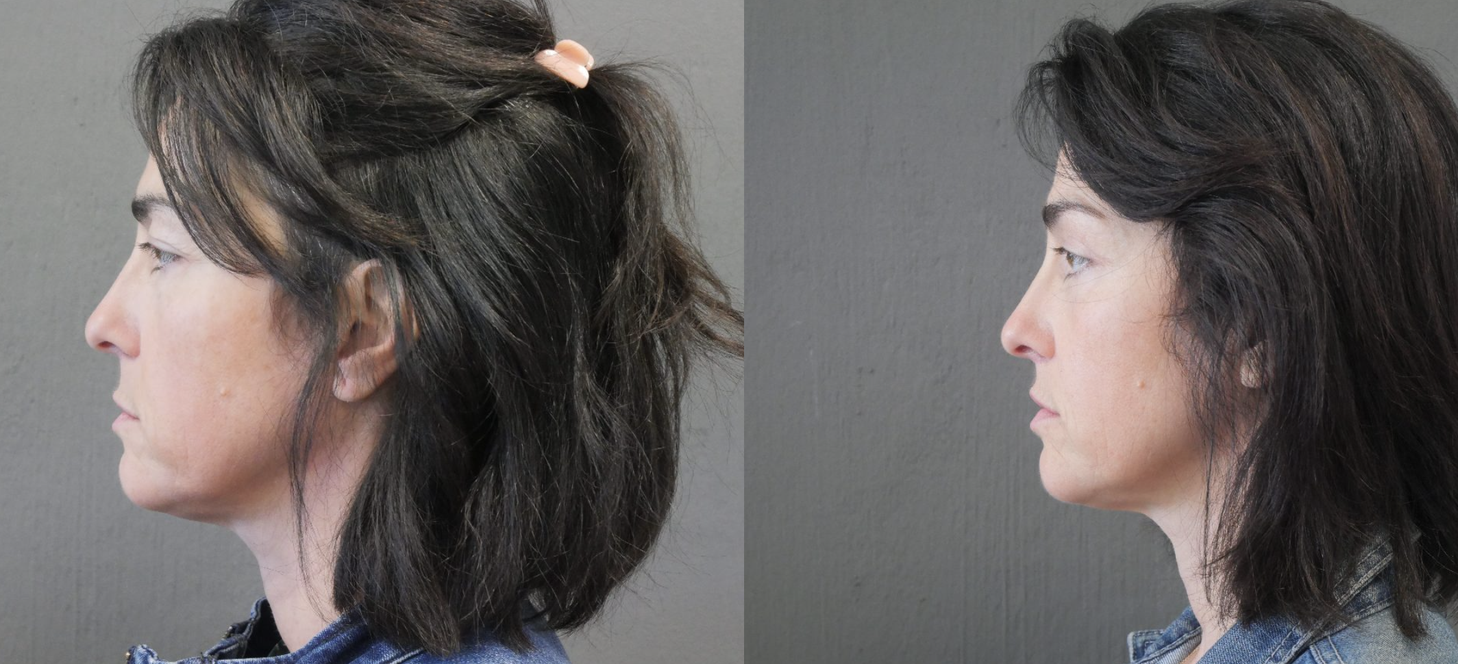 blépharoplastie jessica marthan