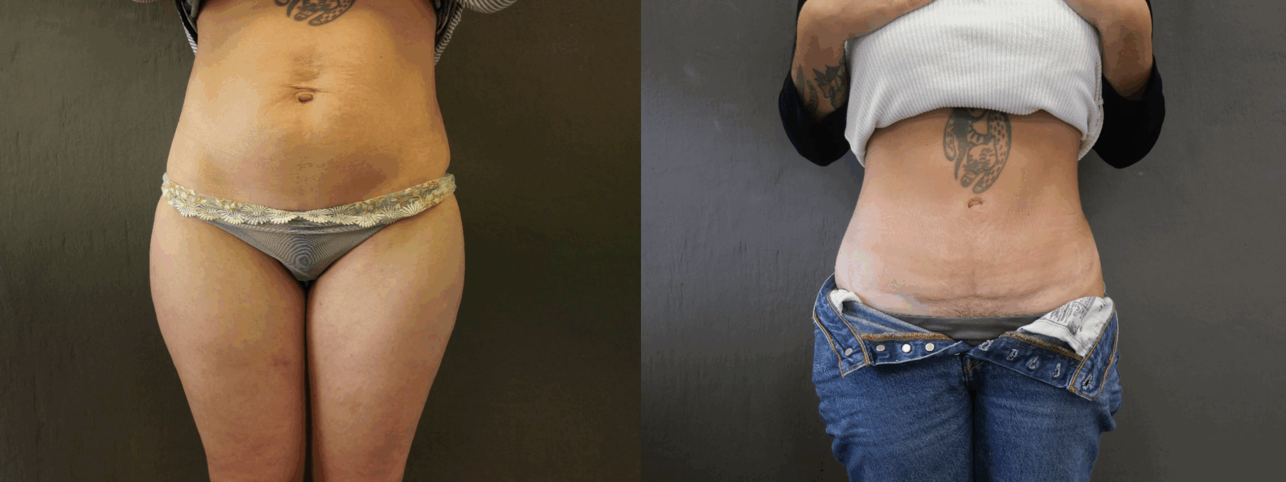 abdominoplastie jessica marthan