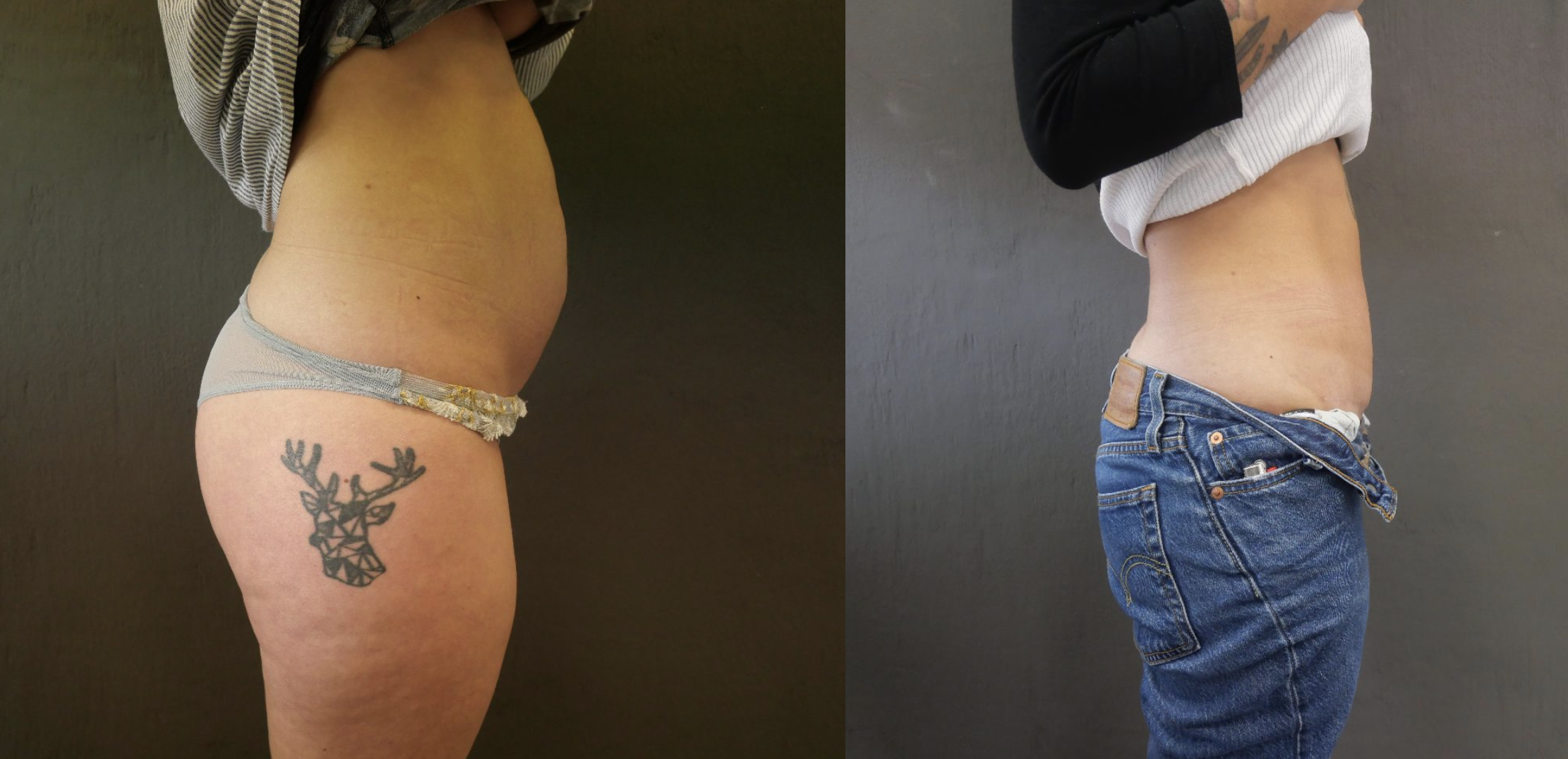 abdominoplastie jessica marthan