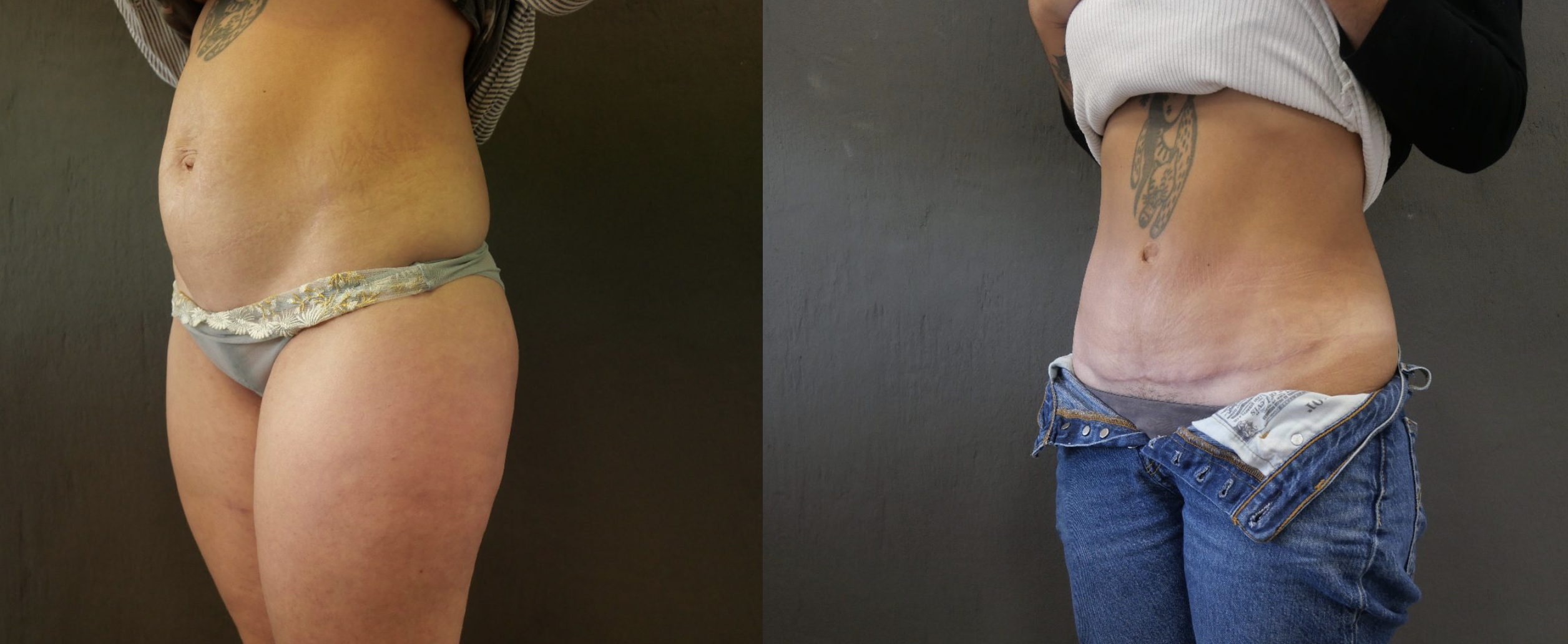 abdominoplastie jessica marthan
