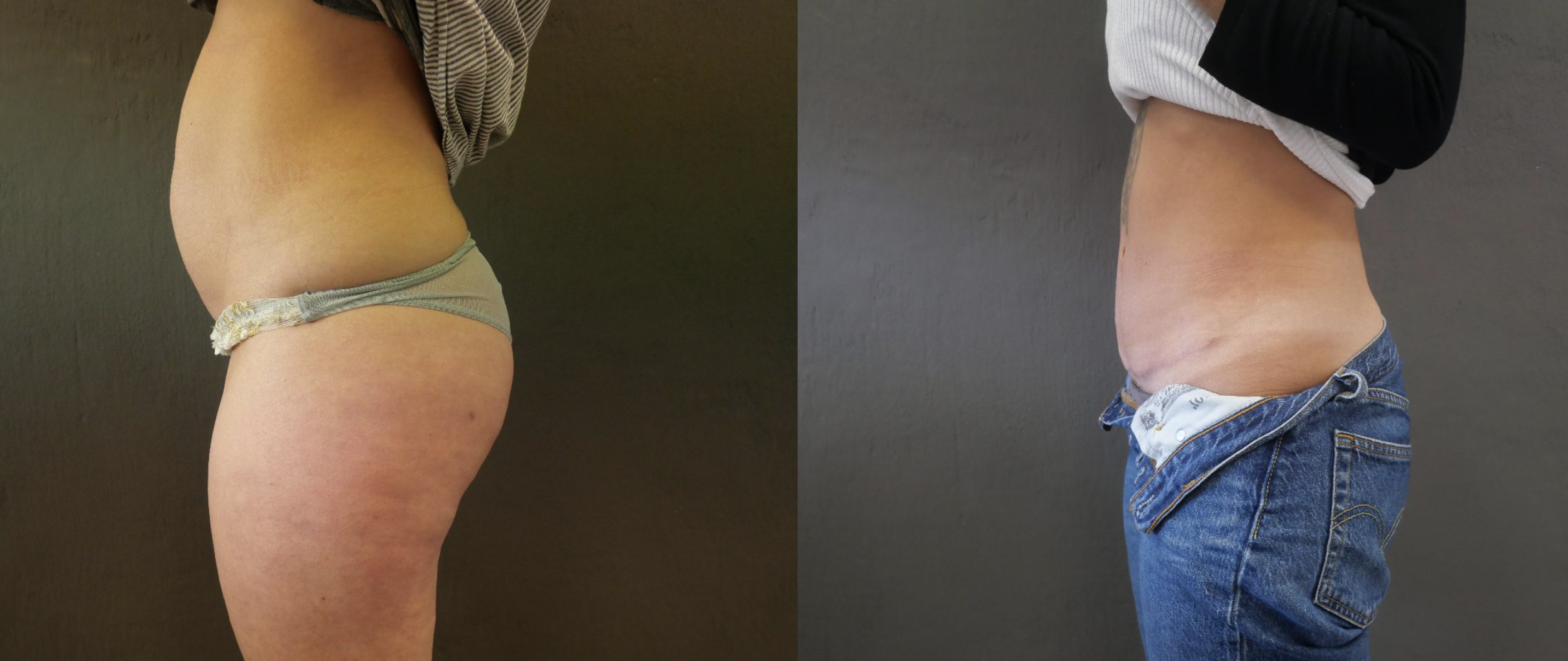 abdominoplastie jessica marthan