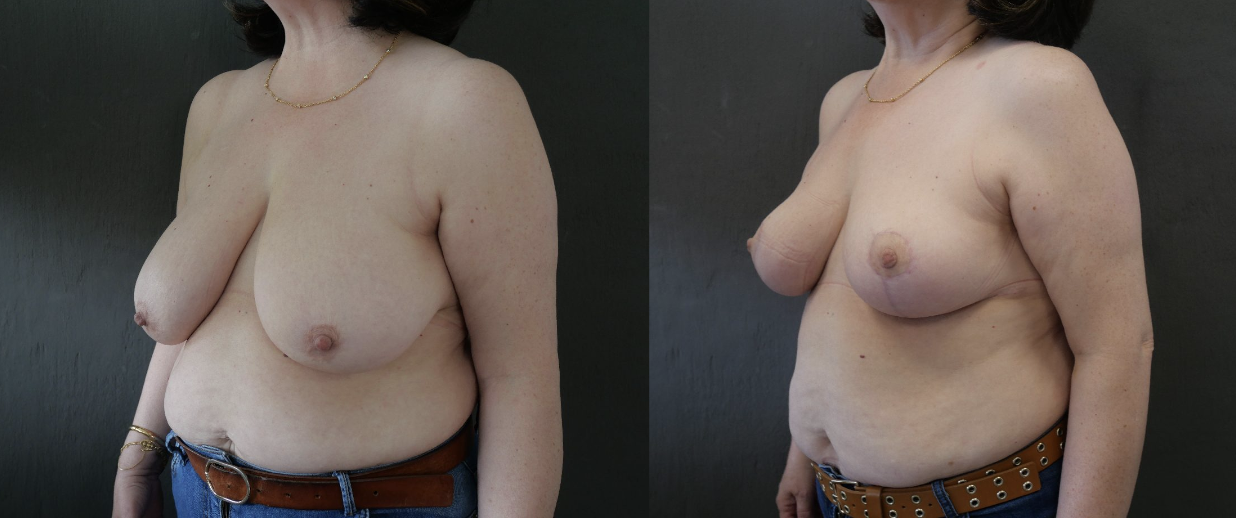 reduction mammaire jessica marthan