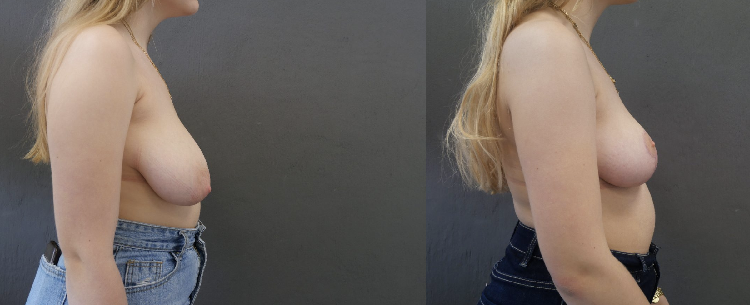 reduction mammaire jessica marthan
