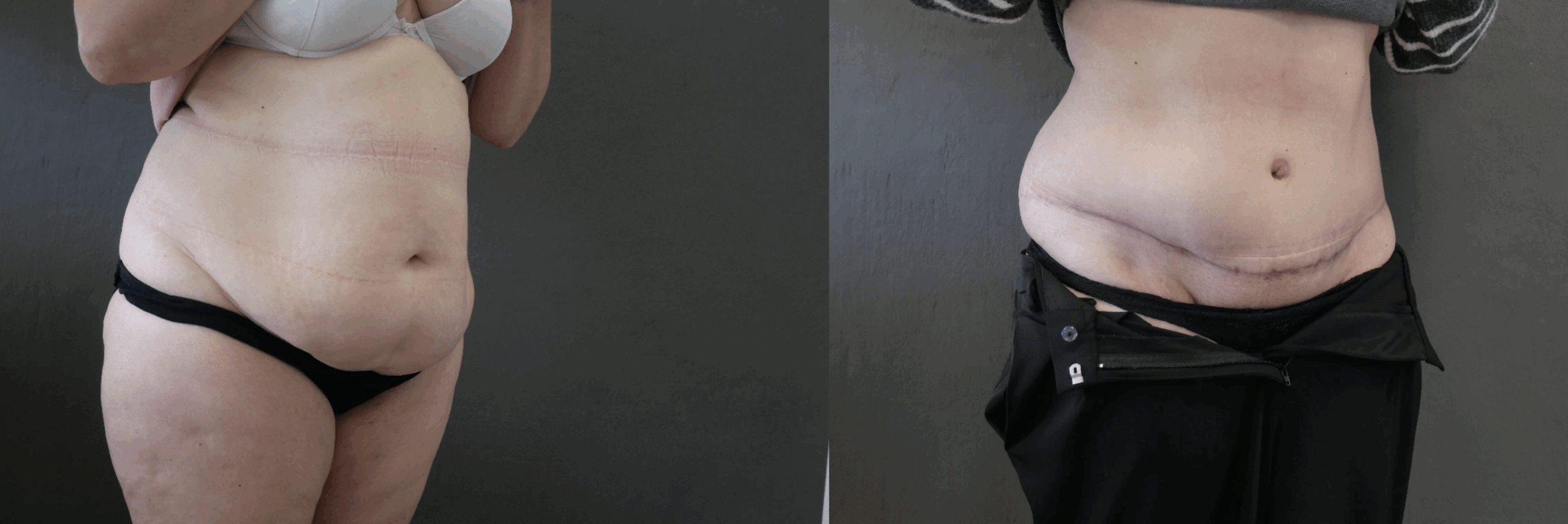 abdominoplastie jessica marthan