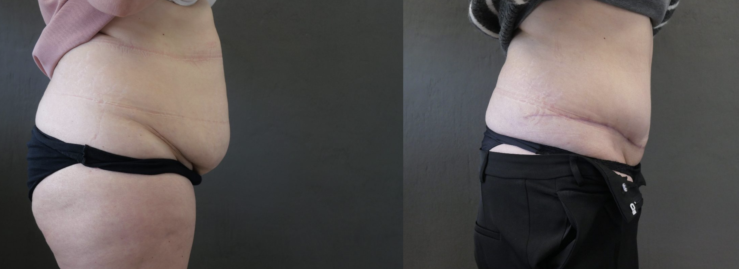 abdominoplastie jessica marthan