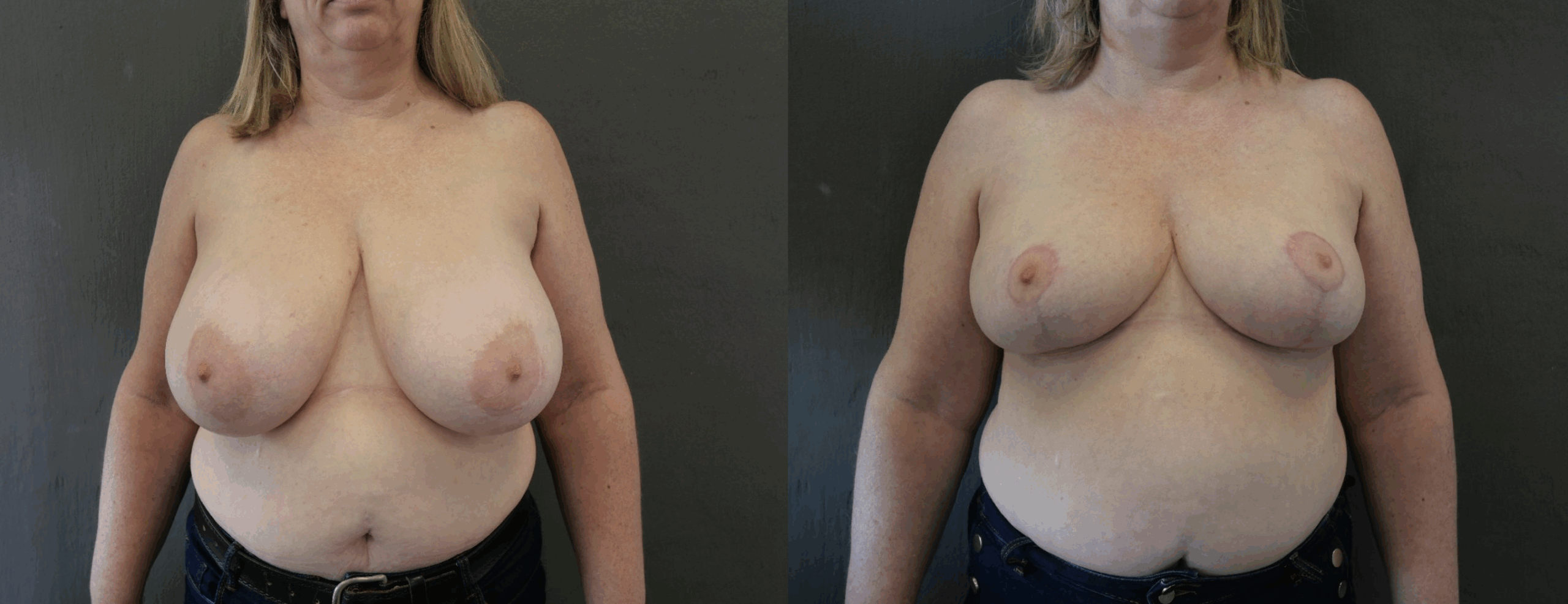 reduction mammaire jessica marthan