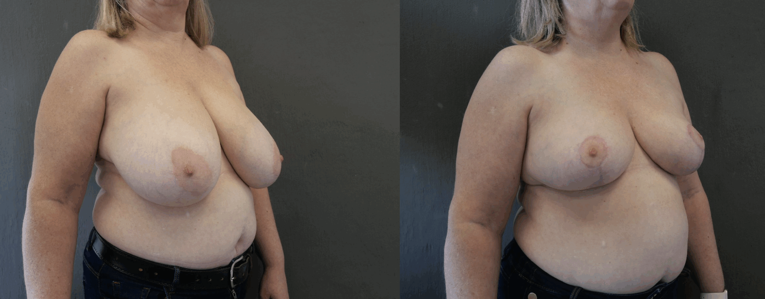 reduction mammaire jessica marthan