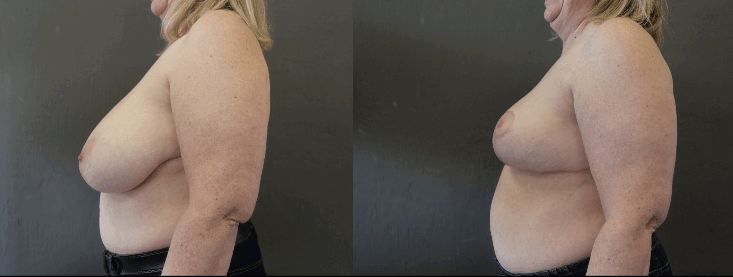 reduction mammaire jessica marthan