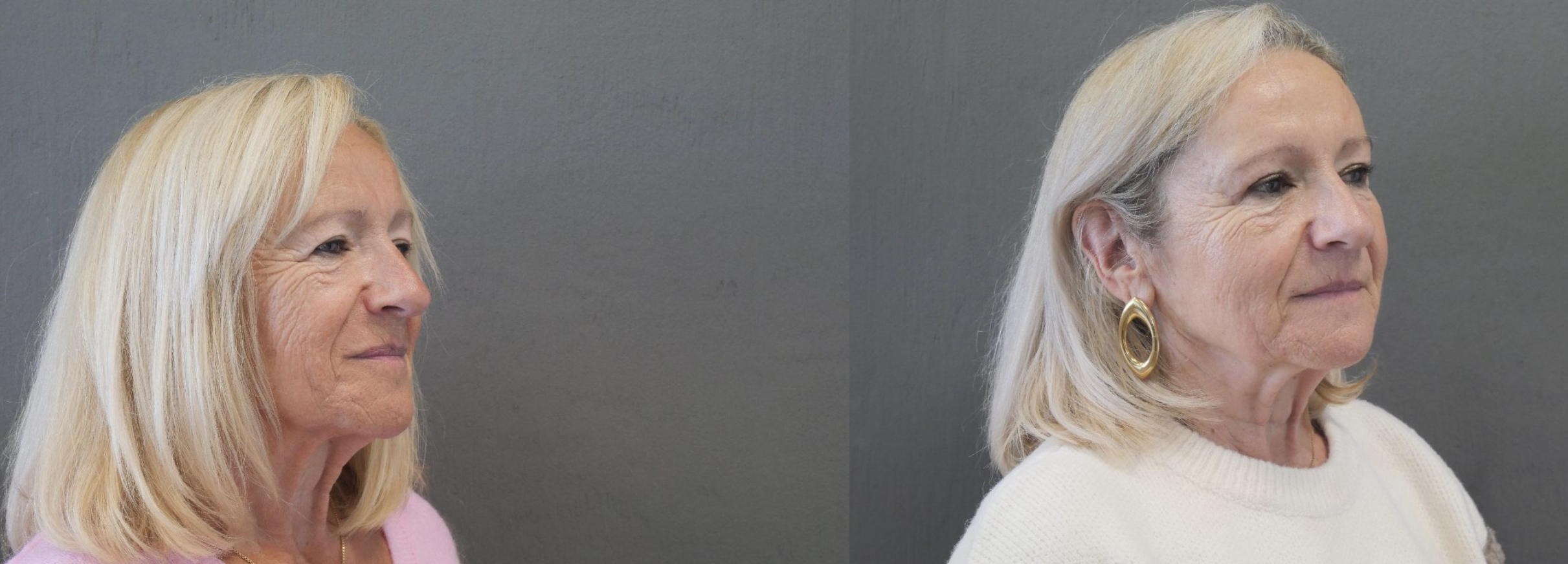 blépharoplastie jessica marthan