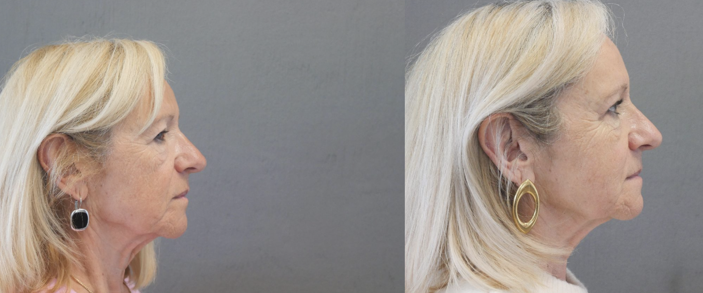 blépharoplastie jessica marthan