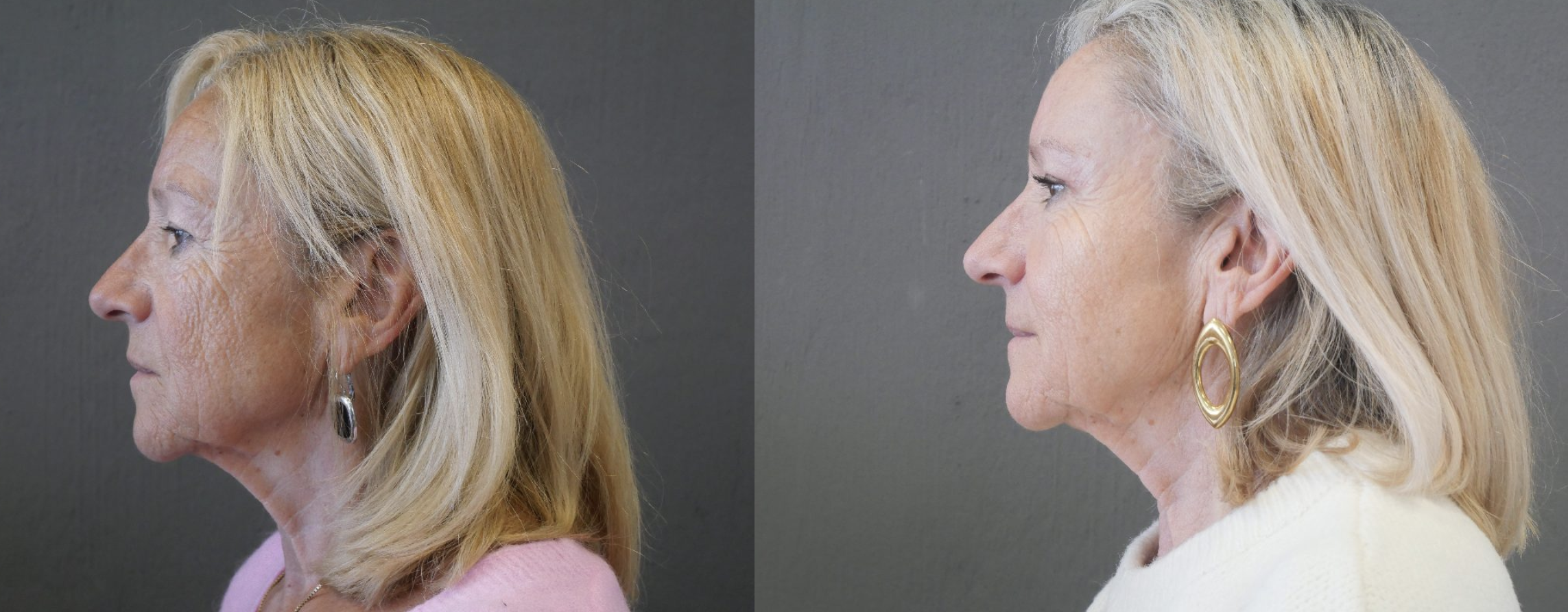 blépharoplastie jessica marthan
