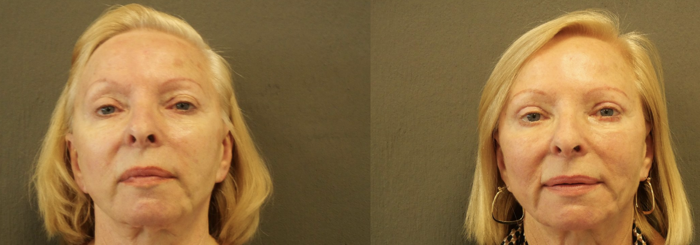 blépharoplastie jessica marthan