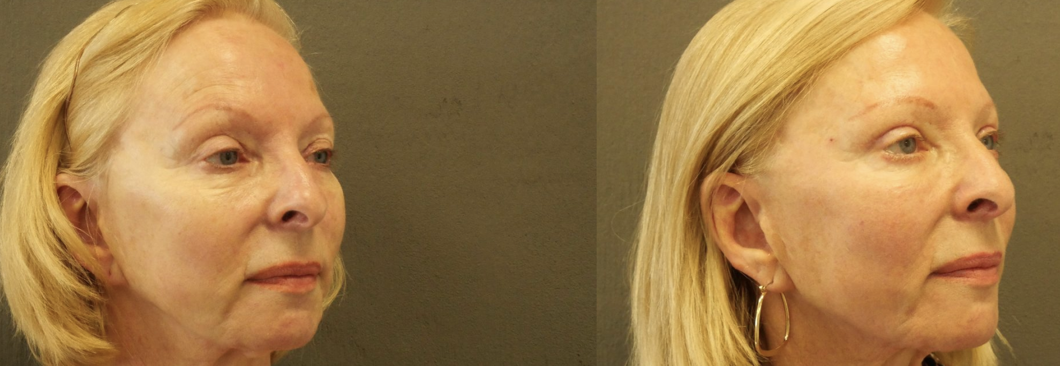 blépharoplastie jessica marthan