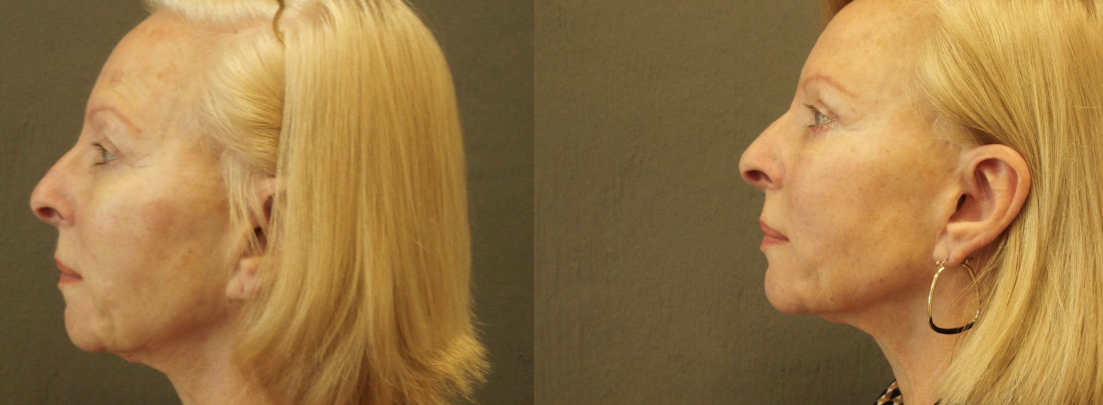 blépharoplastie jessica marthan