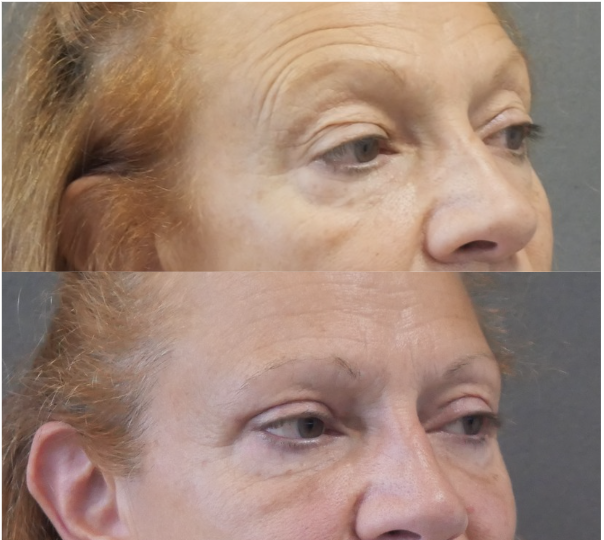 blépharoplastie jessica marthan