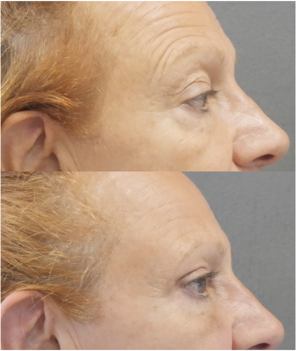 blépharoplastie jessica marthan