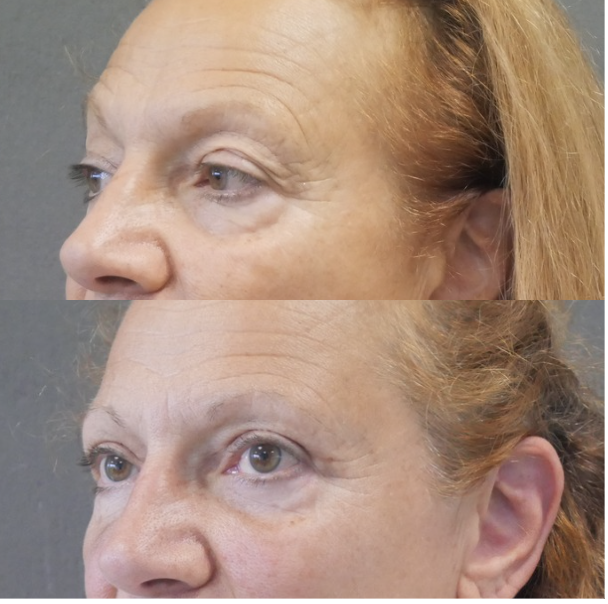 blépharoplastie jessica marthan