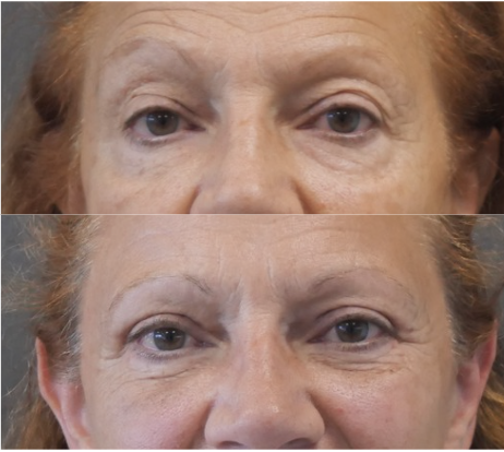 blépharoplastie jessica marthan
