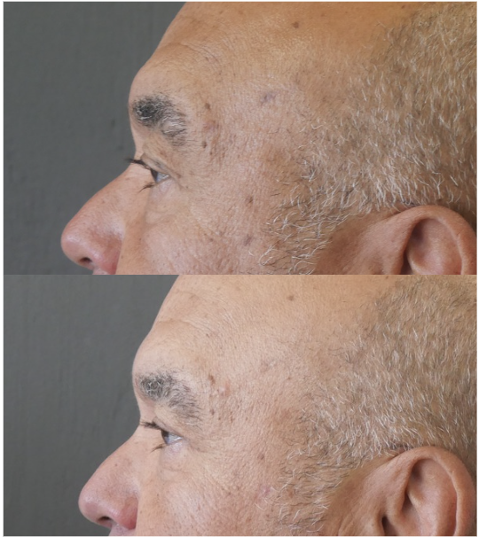blépharoplastie jessica marthan