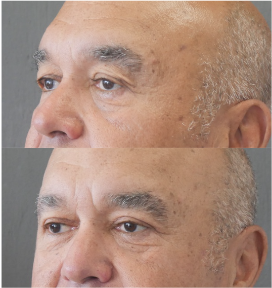 blépharoplastie jessica marthan