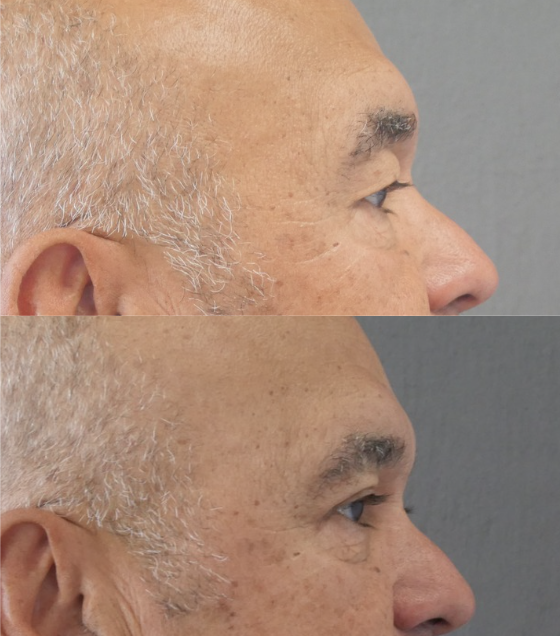 blépharoplastie jessica marthan