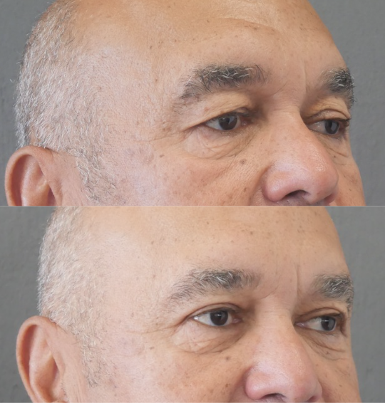 blépharoplastie jessica marthan