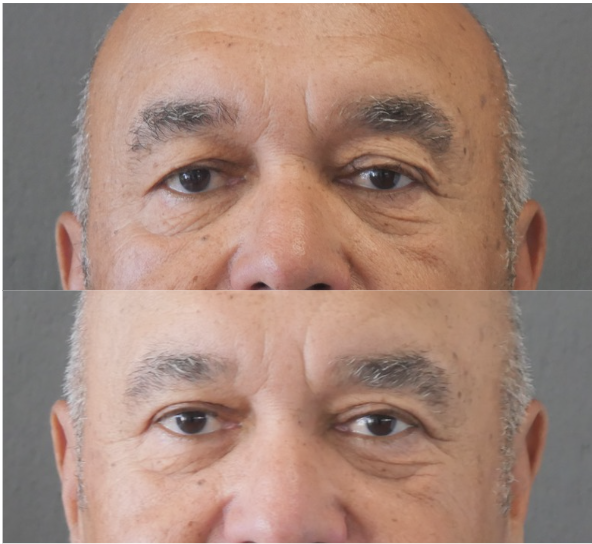 blépharoplastie jessica marthan
