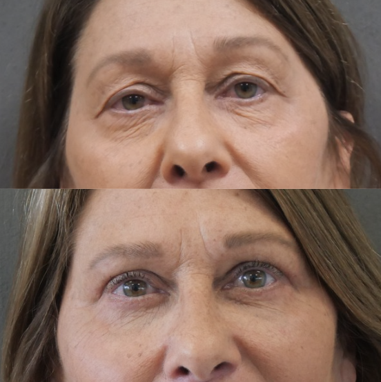 blépharoplastie jessica marthan