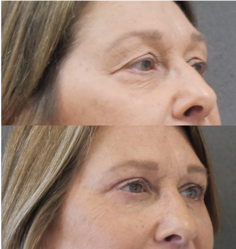 blépharoplastie jessica marthan