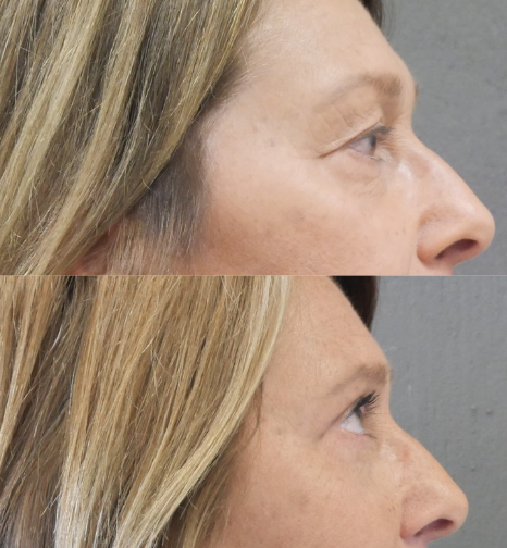 blépharoplastie jessica marthan