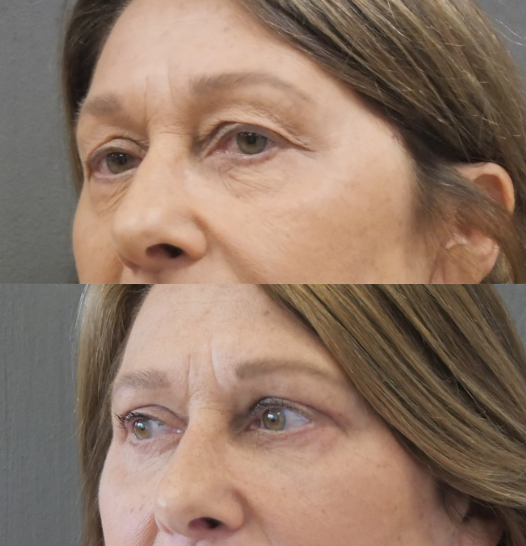 blépharoplastie jessica marthan